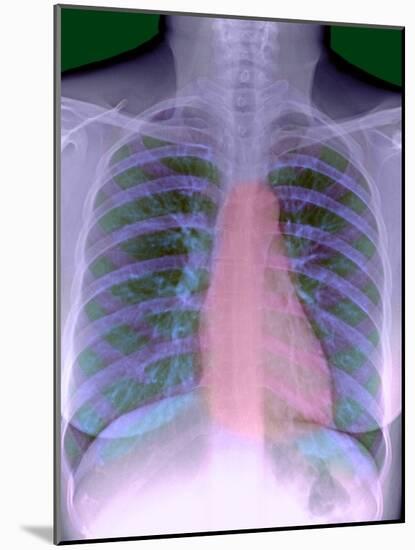 Heart, Chest X-ray-Du Cane Medical-Mounted Photographic Print