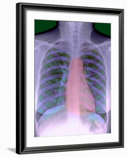 Heart, Chest X-ray-Du Cane Medical-Framed Photographic Print