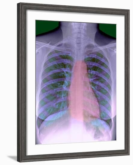 Heart, Chest X-ray-Du Cane Medical-Framed Photographic Print