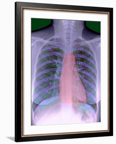 Heart, Chest X-ray-Du Cane Medical-Framed Photographic Print