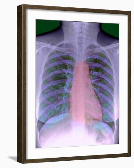 Heart, Chest X-ray-Du Cane Medical-Framed Photographic Print