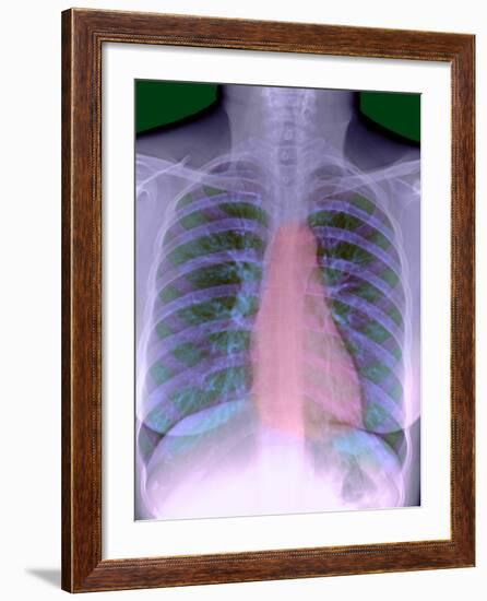 Heart, Chest X-ray-Du Cane Medical-Framed Photographic Print