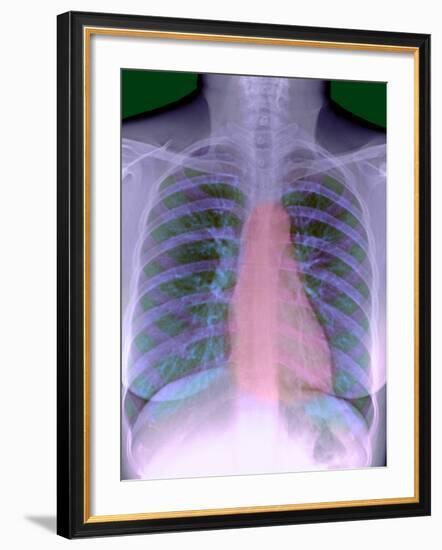 Heart, Chest X-ray-Du Cane Medical-Framed Photographic Print