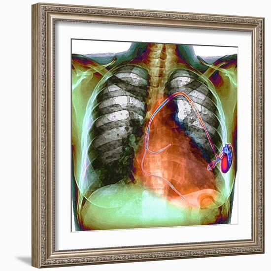 Heart Pacemaker, X-ray-Du Cane Medical-Framed Premium Photographic Print