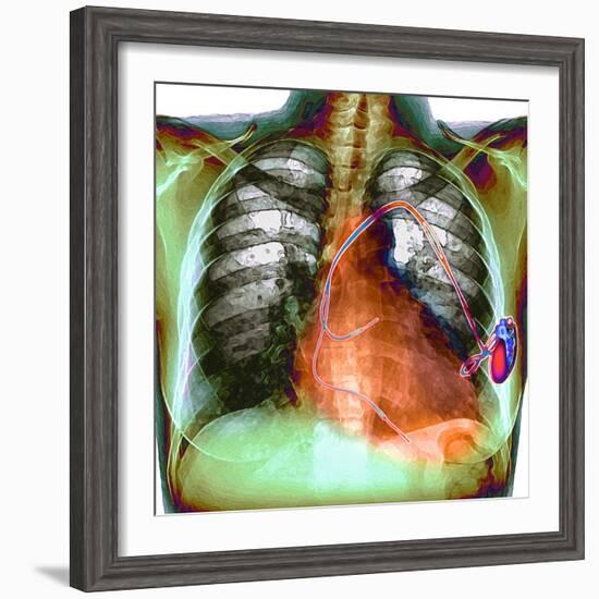 Heart Pacemaker, X-ray-Du Cane Medical-Framed Premium Photographic Print