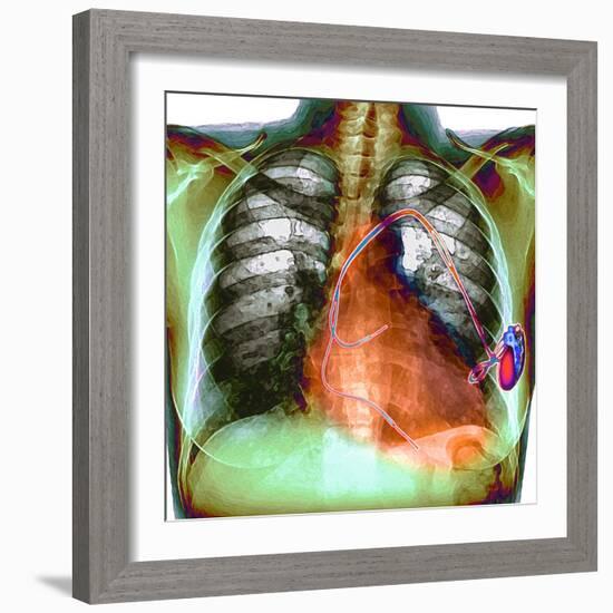 Heart Pacemaker, X-ray-Du Cane Medical-Framed Premium Photographic Print