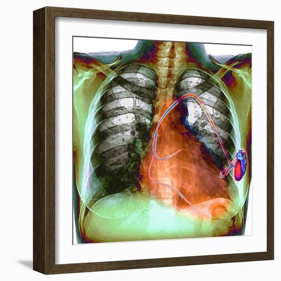 Heart Pacemaker, X-ray-Du Cane Medical-Framed Premium Photographic Print