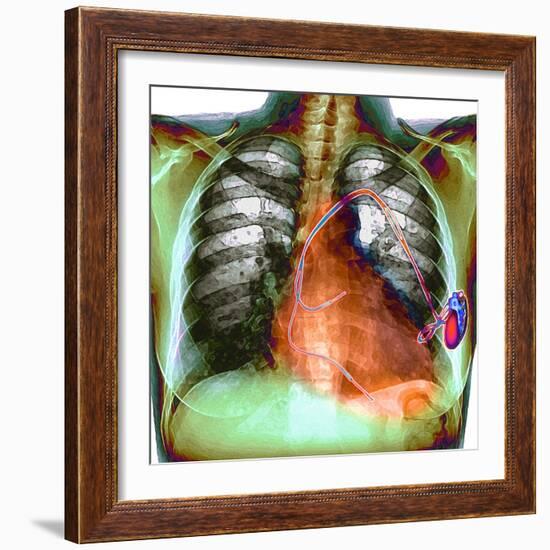 Heart Pacemaker, X-ray-Du Cane Medical-Framed Premium Photographic Print