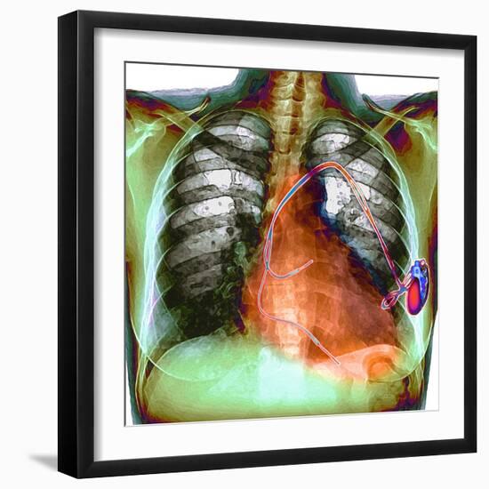 Heart Pacemaker, X-ray-Du Cane Medical-Framed Premium Photographic Print