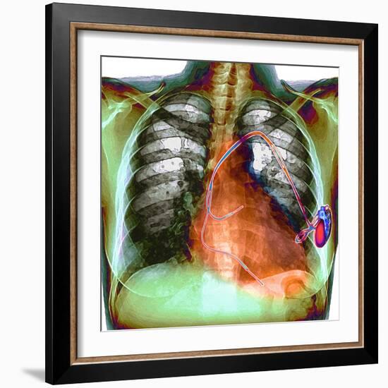 Heart Pacemaker, X-ray-Du Cane Medical-Framed Premium Photographic Print