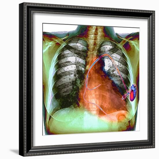 Heart Pacemaker, X-ray-Du Cane Medical-Framed Premium Photographic Print