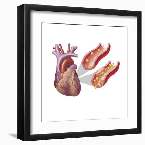 Heart with Arteries Showing Cholesterol in One and Plaque in the Other-null-Framed Art Print
