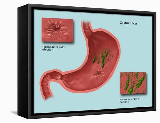 Helicobacter Pylori Infection, Illustration-Gwen Shockey-Framed Premier Image Canvas