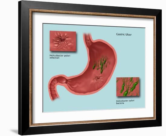 Helicobacter Pylori Infection, Illustration-Gwen Shockey-Framed Giclee Print