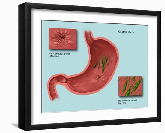 Helicobacter Pylori Infection, Illustration-Gwen Shockey-Framed Giclee Print