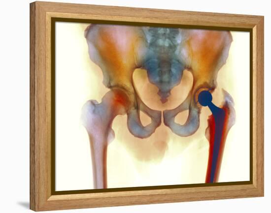 Hip Joint Replacement, X-ray-Science Photo Library-Framed Premier Image Canvas