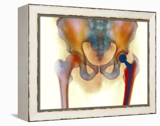 Hip Joint Replacement, X-ray-Science Photo Library-Framed Premier Image Canvas