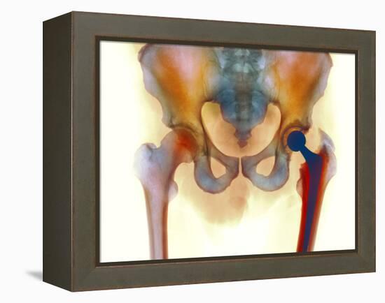 Hip Joint Replacement, X-ray-Science Photo Library-Framed Premier Image Canvas