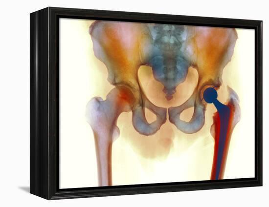 Hip Joint Replacement, X-ray-Science Photo Library-Framed Premier Image Canvas