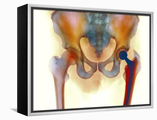 Hip Joint Replacement, X-ray-Science Photo Library-Framed Premier Image Canvas