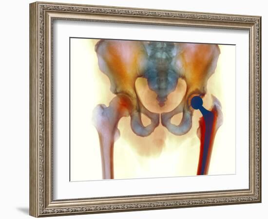 Hip Joint Replacement, X-ray-Science Photo Library-Framed Photographic Print