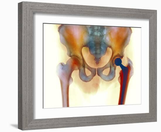 Hip Joint Replacement, X-ray-Science Photo Library-Framed Photographic Print