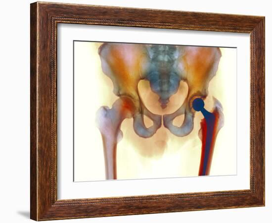 Hip Joint Replacement, X-ray-Science Photo Library-Framed Photographic Print