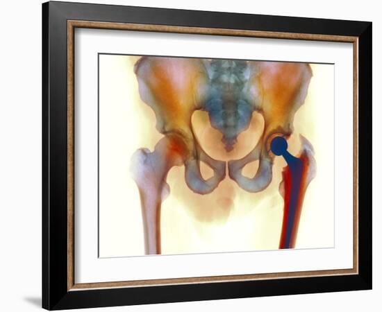 Hip Joint Replacement, X-ray-Science Photo Library-Framed Photographic Print