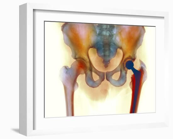 Hip Joint Replacement, X-ray-Science Photo Library-Framed Photographic Print