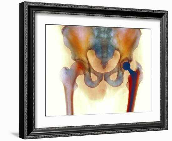 Hip Joint Replacement, X-ray-Science Photo Library-Framed Photographic Print