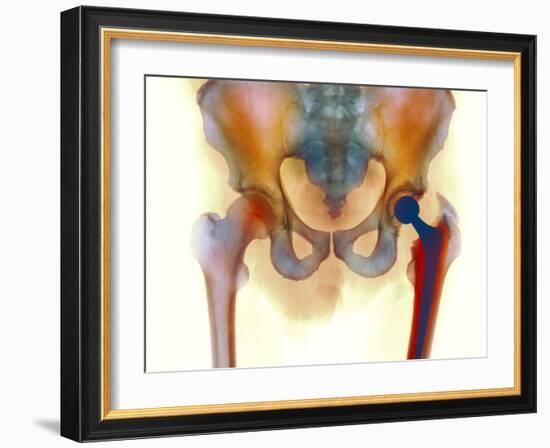 Hip Joint Replacement, X-ray-Science Photo Library-Framed Photographic Print