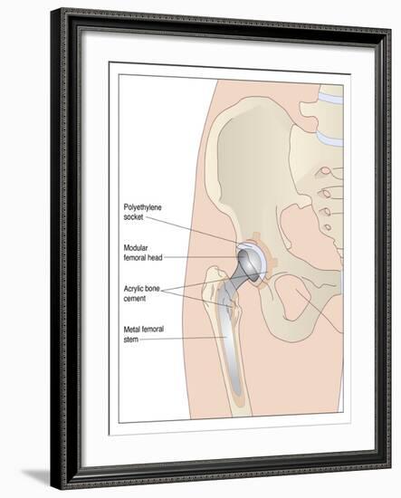 Hip Replacement, Artwork-Peter Gardiner-Framed Photographic Print