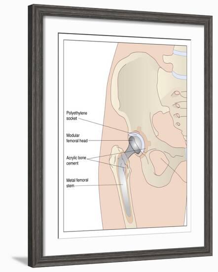 Hip Replacement, Artwork-Peter Gardiner-Framed Photographic Print