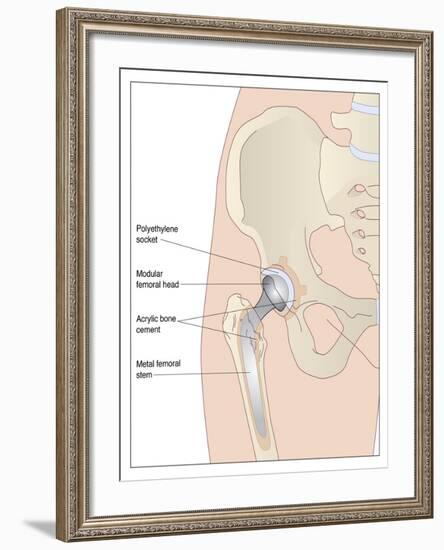 Hip Replacement, Artwork-Peter Gardiner-Framed Photographic Print