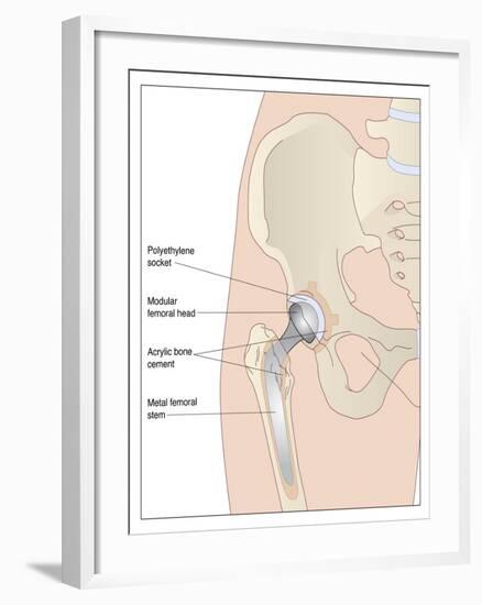 Hip Replacement, Artwork-Peter Gardiner-Framed Photographic Print