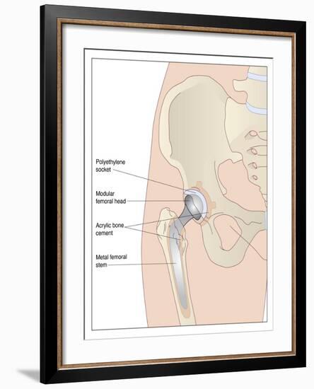 Hip Replacement, Artwork-Peter Gardiner-Framed Photographic Print