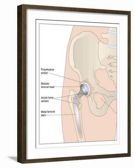 Hip Replacement, Artwork-Peter Gardiner-Framed Photographic Print