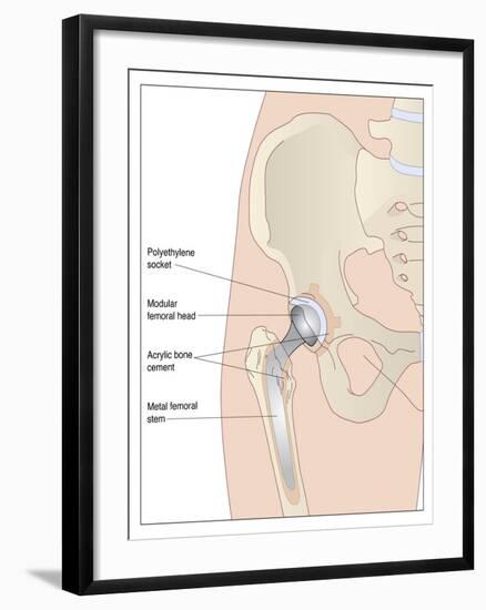 Hip Replacement, Artwork-Peter Gardiner-Framed Photographic Print