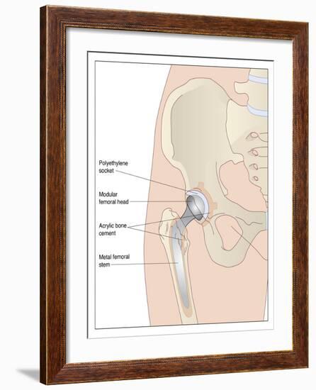 Hip Replacement, Artwork-Peter Gardiner-Framed Photographic Print