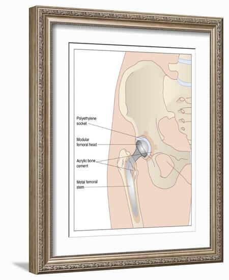 Hip Replacement, Artwork-Peter Gardiner-Framed Photographic Print