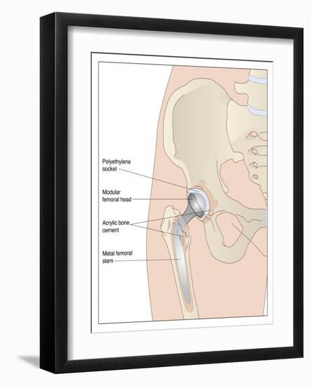 Hip Replacement, Artwork-Peter Gardiner-Framed Photographic Print