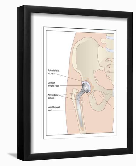 Hip Replacement, Artwork-Peter Gardiner-Framed Photographic Print