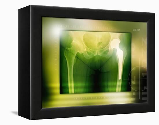 Hip Replacement, X-ray-Miriam Maslo-Framed Premier Image Canvas