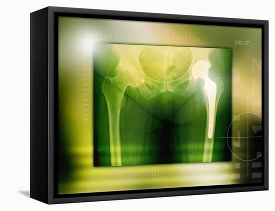 Hip Replacement, X-ray-Miriam Maslo-Framed Premier Image Canvas