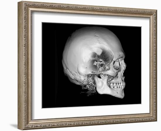 Human Skull and Site of Pituitary Gland, CT and MRI Scans-null-Framed Photographic Print