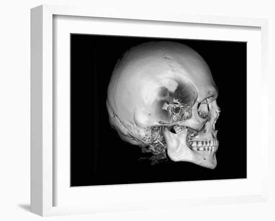 Human Skull and Site of Pituitary Gland, CT and MRI Scans-null-Framed Photographic Print