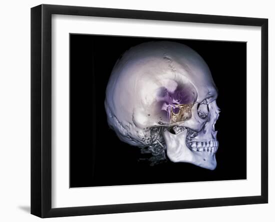 Human Skull and Site of Pituitary Gland, CT and MRI Scans-null-Framed Photographic Print