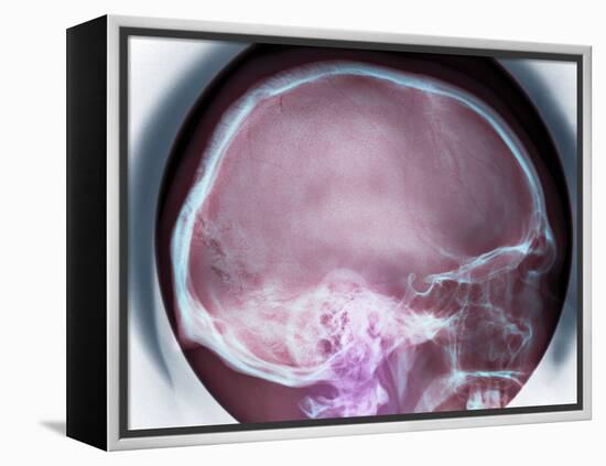 Human Skull, X-ray-Du Cane Medical-Framed Premier Image Canvas