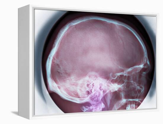 Human Skull, X-ray-Du Cane Medical-Framed Premier Image Canvas