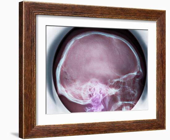 Human Skull, X-ray-Du Cane Medical-Framed Photographic Print